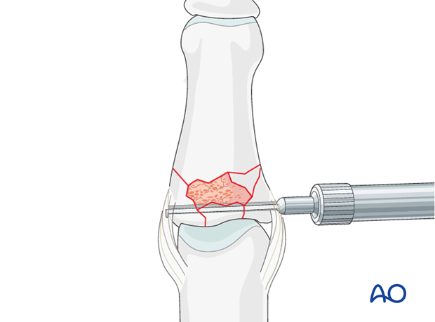 minicondylar plate fixation of pilon compression fracture