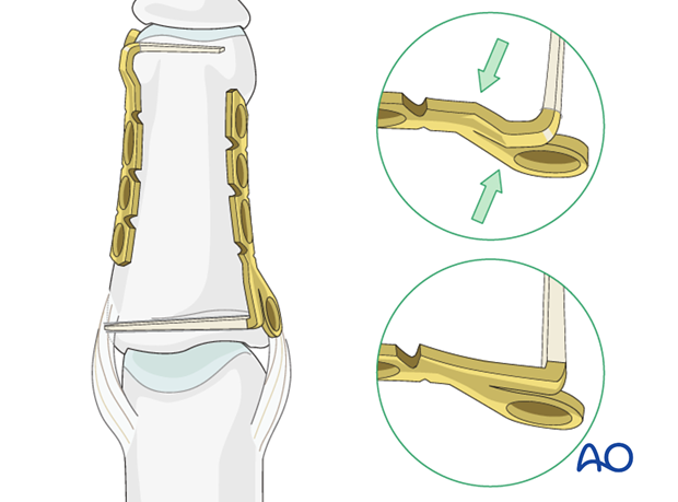 Use pliers to contour the plate so that it fits exactly the anatomy of the base of the proximal phalanx. 