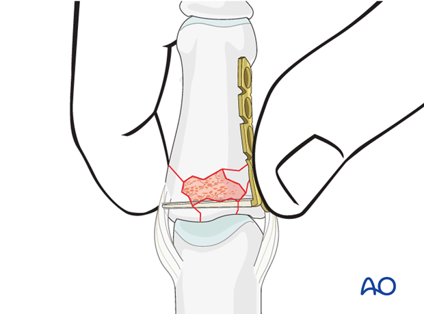 minicondylar plate fixation of pilon compression fracture