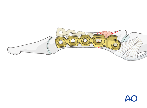 minicondylar plate fixation of pilon compression fracture