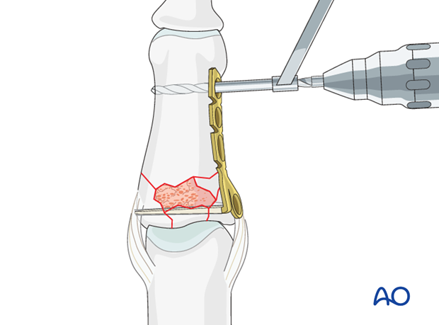 minicondylar plate fixation of pilon compression fracture