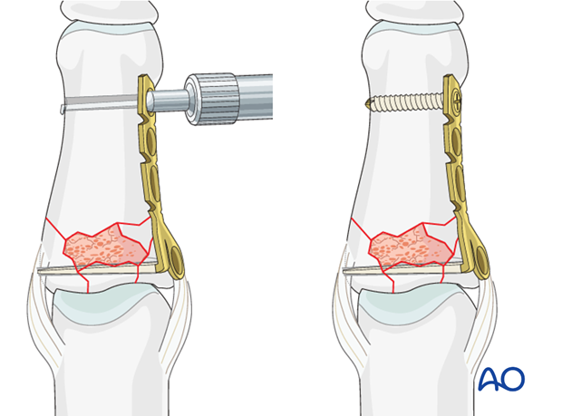 minicondylar plate fixation of pilon compression fracture