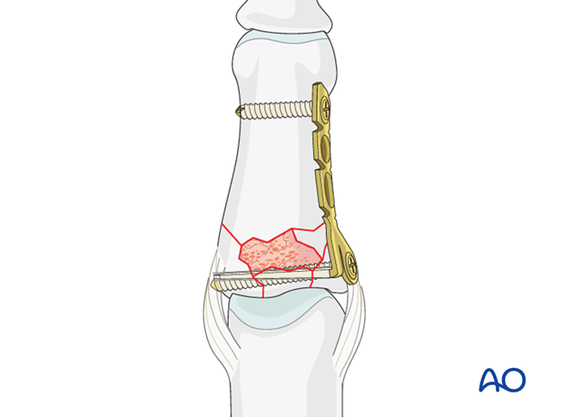 minicondylar plate fixation of pilon compression fracture