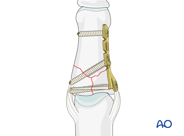 minicondylar plate fixation of pilon compression fracture