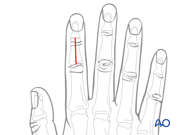 The dorsal approach is indicated for oblique, spiral, comminuted, or transverse fractures of the diaphysis, or metaphysis ...