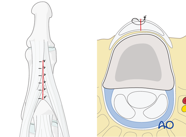 The terminal extensor tendon and its triangular ligament should be repaired with fine interrupted mattress sutures.