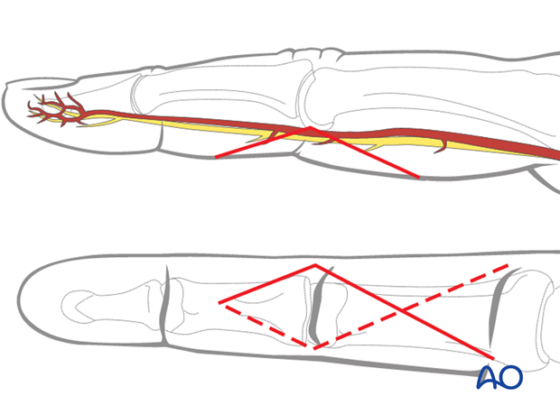 The palmar approach is indicated mainly for volar plate avulsion fractures of the base of the middle phalanx, ...