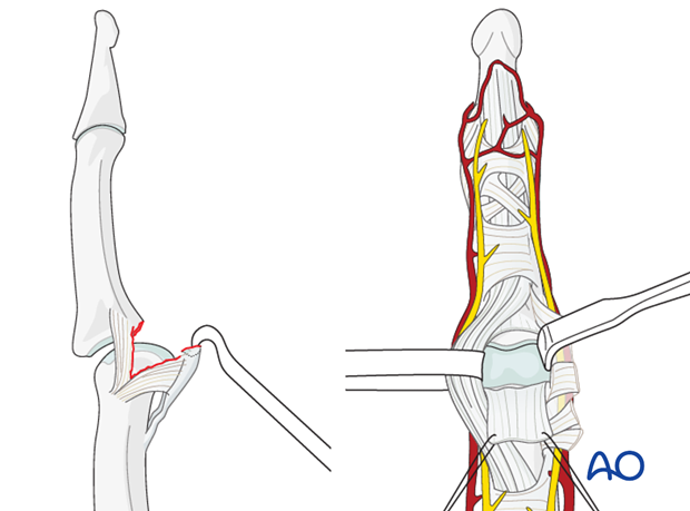 Palmar approach to the PIP joint