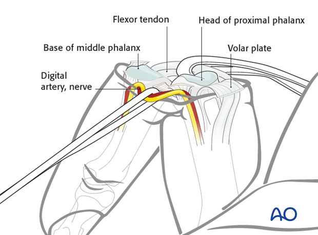 After detachment of the collateral ligaments, the finger can be fully hyperextended (as in breaking open a shotgun).