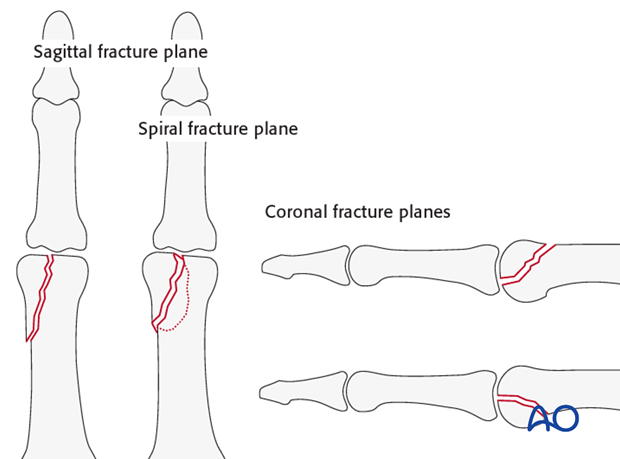 Intraarticular fractures in the interphalangeal joints may lie in the sagittal plane or the coronal plane.