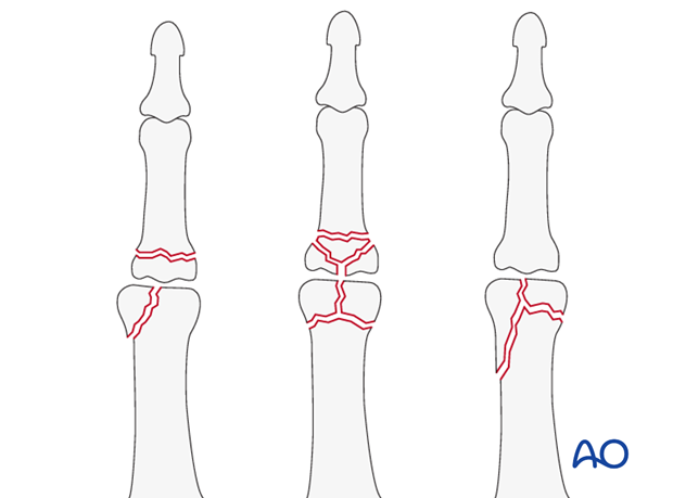 This approach is indicated for intra- or extraarticular basal, or condylar fractures. It is also used for irreducible ...