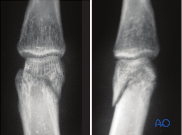 This approach is also used for juxtaarticular fractures.