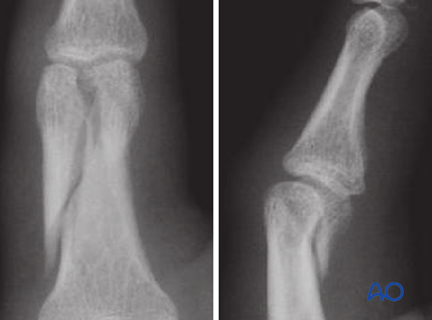 It is occasionally used for bicondylar fractures with an extension into the diaphysis, but only if the contralateral ...