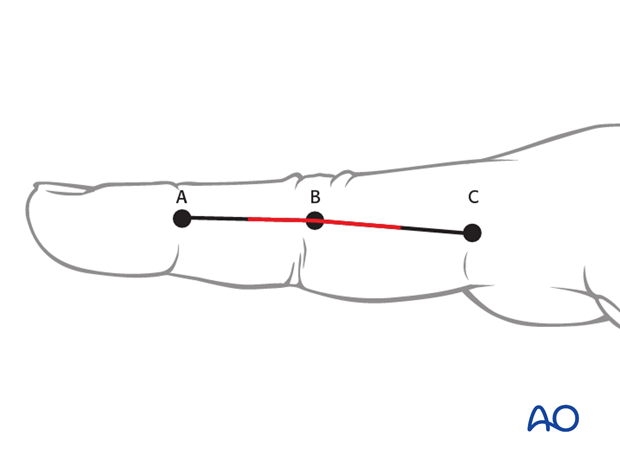 Make a skin incision from the middle point between A and B to the middle point between B and C.