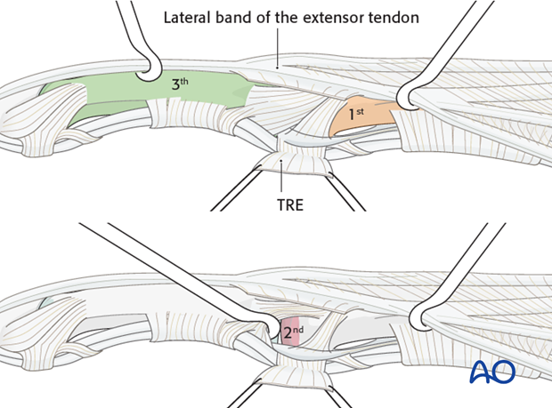 The dorsal fringe of the TRL is then retracted dorsally with the lateral band of the extensor tendon, to expose the ...