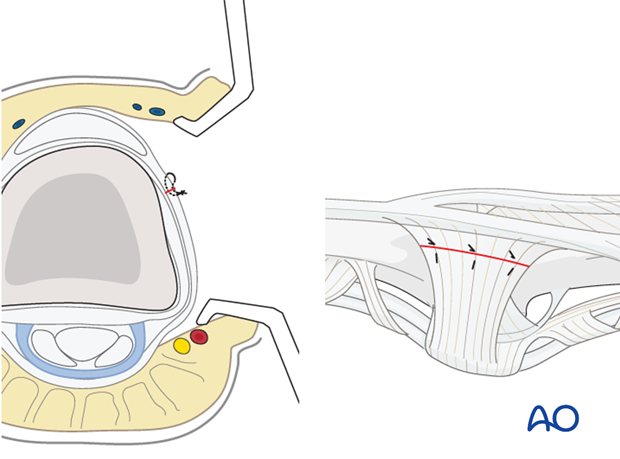 Repair the TRL with multiple fine mattress sutures before closing the skin.