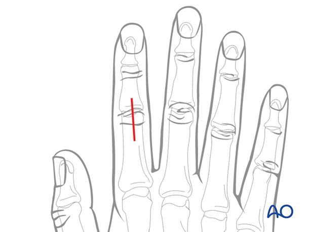 Make a straight midline dorsal incision over the PIP joint.