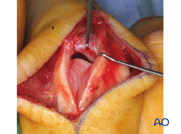 Caution: Avoid detachment of the extensor central slip and of the collateral ligaments.