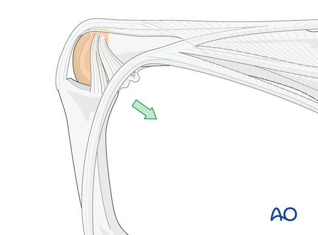 Flexing the PIP joint allows the lateral band to move in a palmar direction to give a better exposure of the joint.