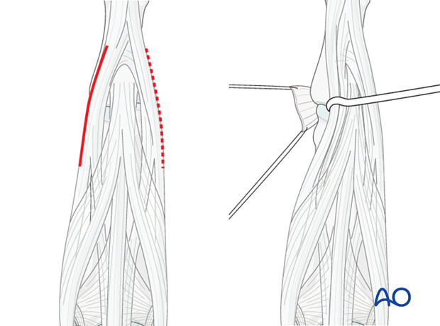 This dorsolateral approach does not allow access to the opposite condyle which in some situations is necessary, notably ...