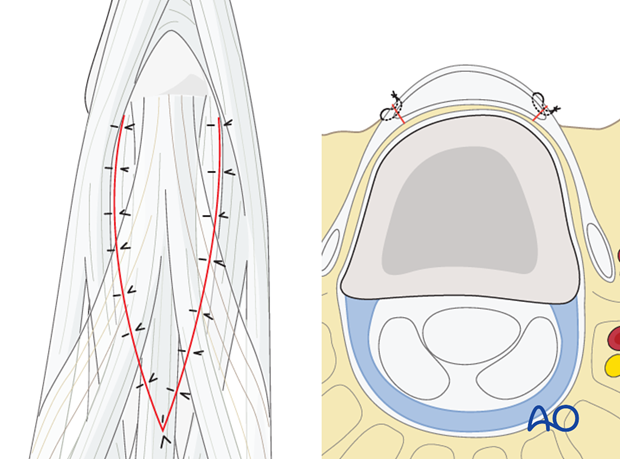 Regardless of the approach chosen, all tendon incisions need to be sutured prior to wound closure.