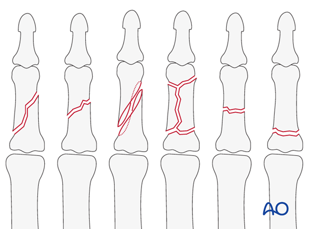 The midaxial approach is indicated for oblique, spiral, comminuted, or transverse fractures of the diaphysis, or metaphysis, ...