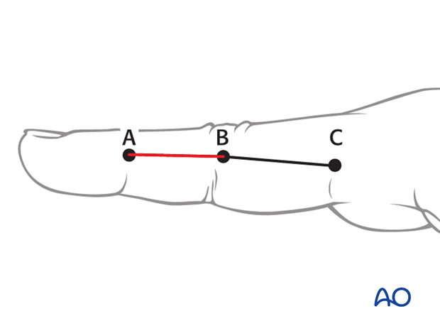 The midaxial approach is indicated for oblique, spiral, comminuted, or transverse fractures of the diaphysis, or metaphysis, ...