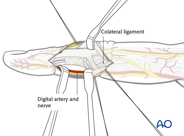 The palmar remainder of the TRL is retracted in a palmar direction, using two fine sutures ...