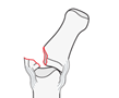 Contour defects