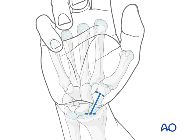 Marking the skin during minimally invasive palmar approach to the scaphoid