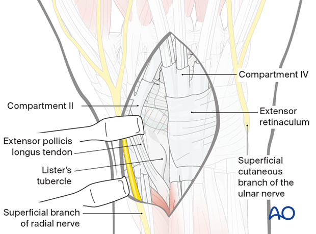 Release and radial retraction of the 2nd compartment tendons in a dorsal approach to the wrist