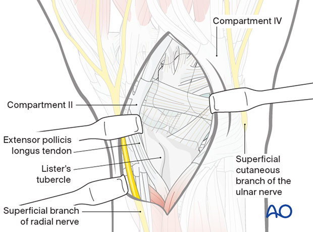 Elevating the 4th compartment in a dorsal approach to the wrist