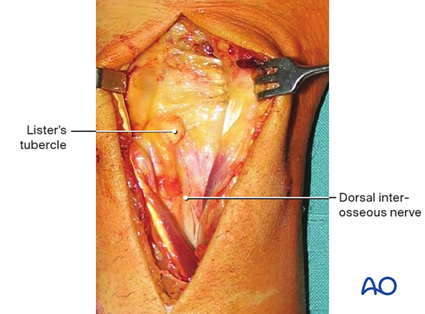 Intraoperative image showing the exposure of the wrist capsule after retraction of dorsal compartments