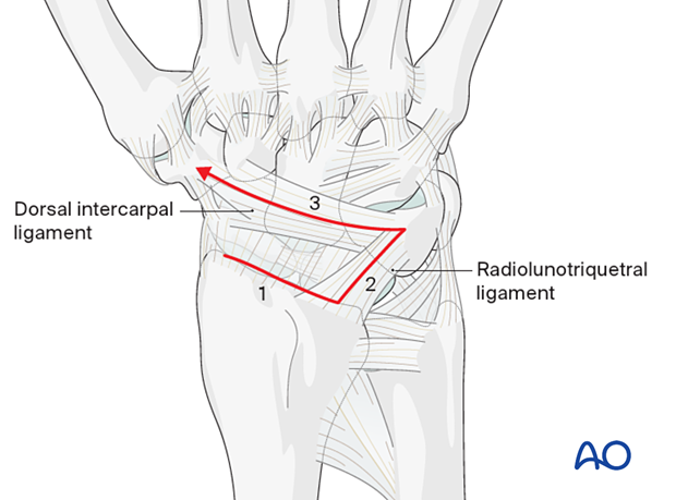 Capsulotomy of the dorsal aspect of the carpus