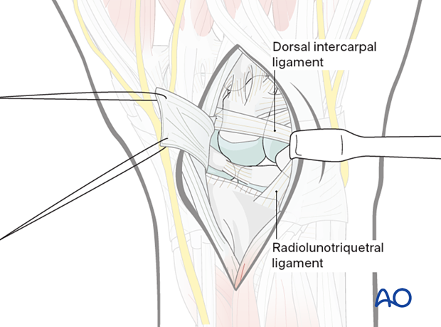 Capsulotomy of the dorsal aspect of the carpus with elevation of the capsular flap