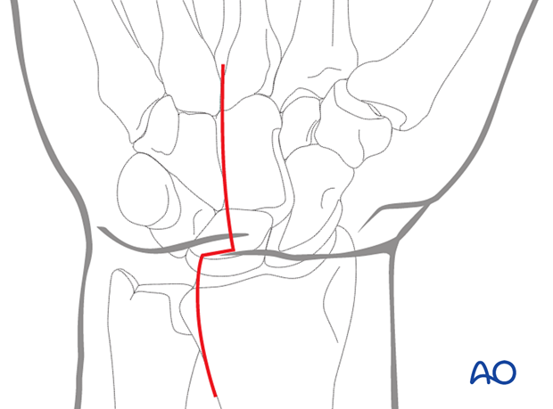 Extended carpal tunnel incision