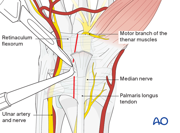 Extended carpal tunnel incision - Opening the carpal tunnel