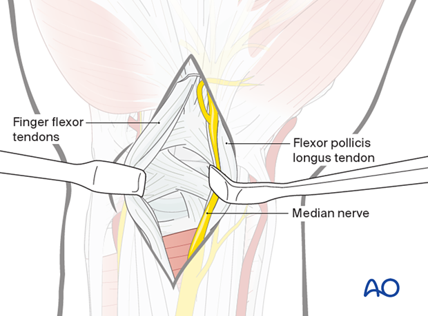 Approach to the radial palmar capsule