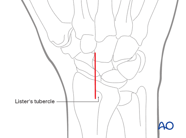 Skin incision during dorsal approach to the scaphoid