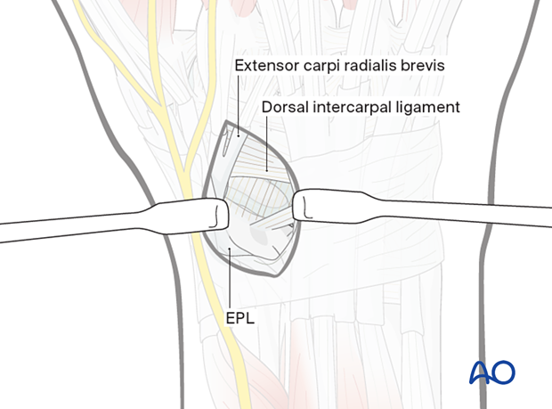 Retraction of the tendons during dorsal approach to the scaphoid