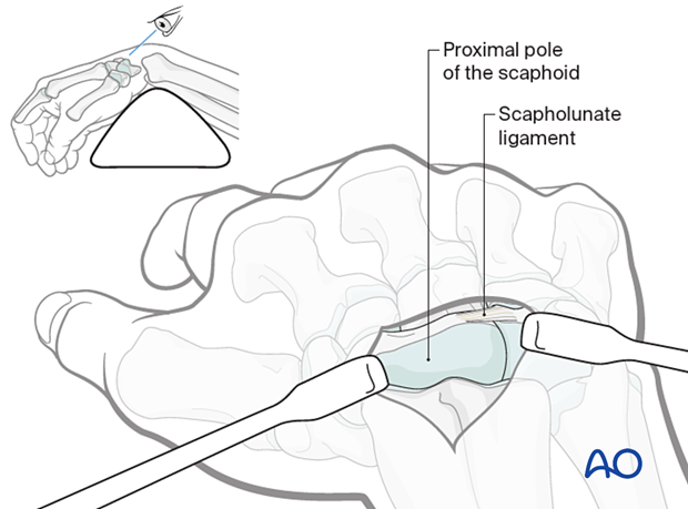 Exposure of the scaphoid during dorsal approach