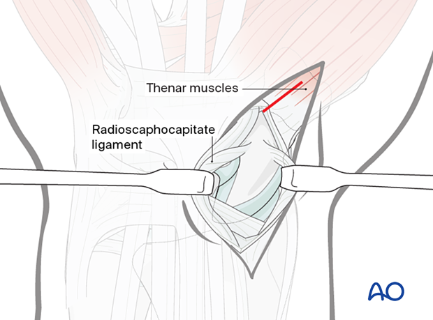 Palmar approach to the scaphoid – Exposure of scaphotrapezial joint