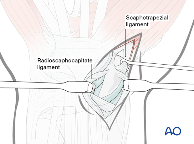 Palmar approach to the scaphoid – Dividing the scaphotrapezial ligament during exposure of scaphotrapezial joint