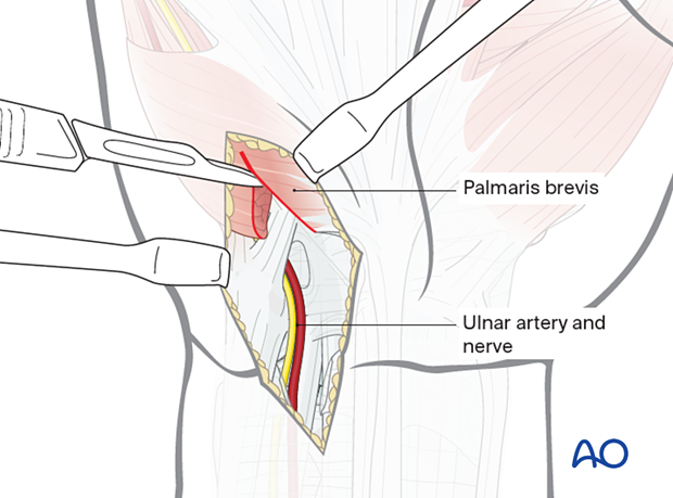 Dividing the palmaris brevis during ulnar approach to the hamate hook