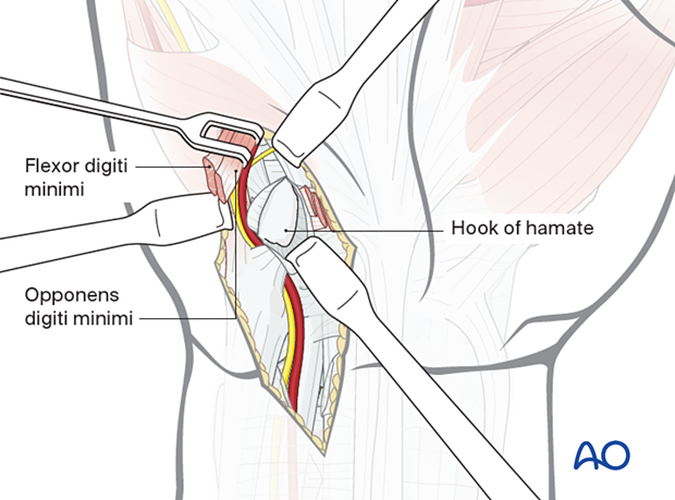 Exposing the hook subperiosteally during the ulnar approach to the hamate hook