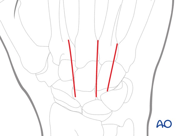 Dorsal approach to the carpometacarpal joints