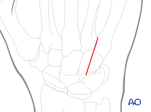 Dorsal approach to the carpometacarpal joints