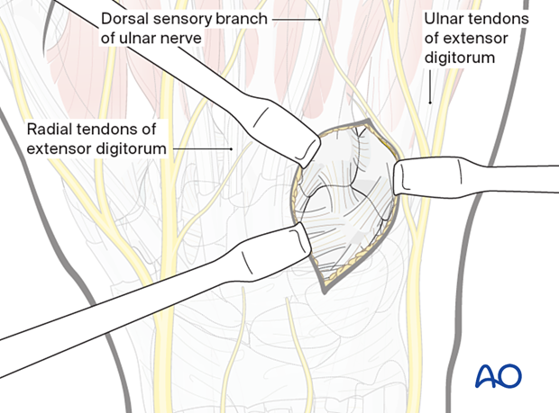 Dorsal approach to the carpometacarpal joints: Retraction of extensor tendons