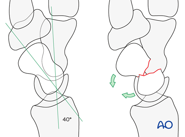 Scaphoid waist fracture - fracture displacement forces