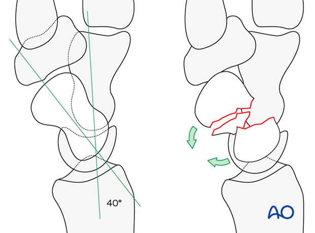 Scaphoid displaced waist fractures – fracture displacement forces